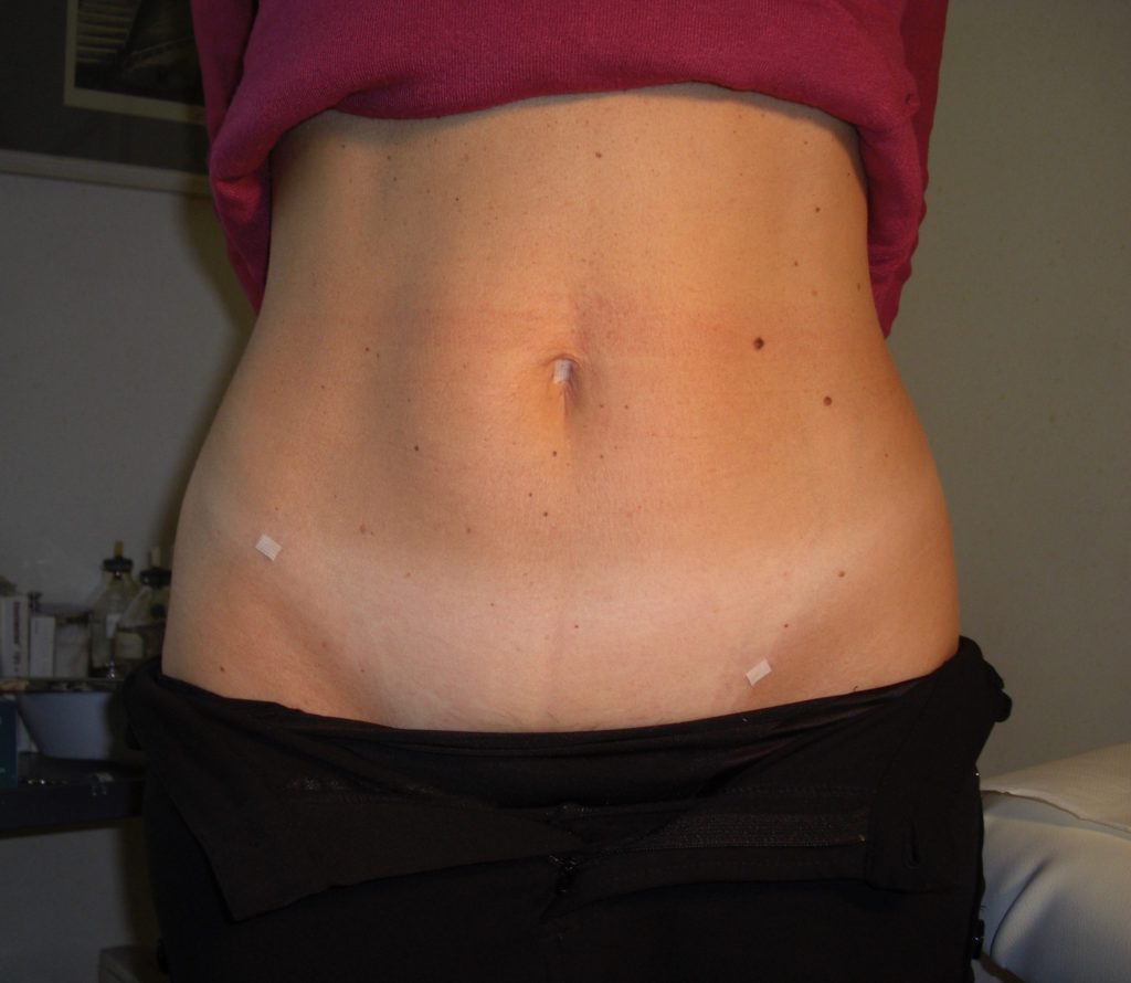 Mini laparoscopia