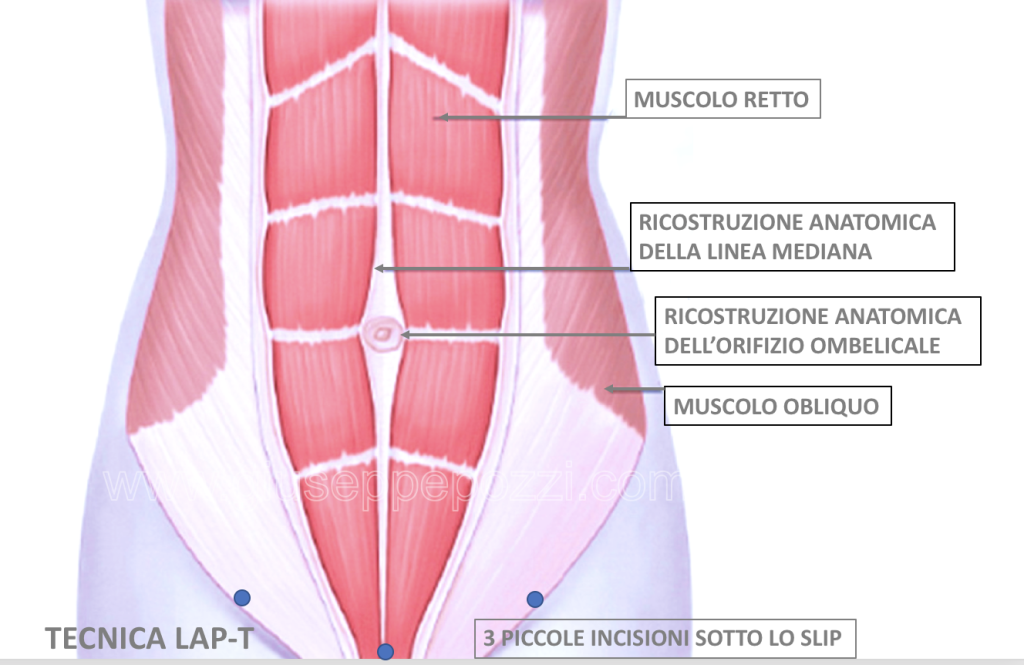 Articoli e news tecnica LAP-T