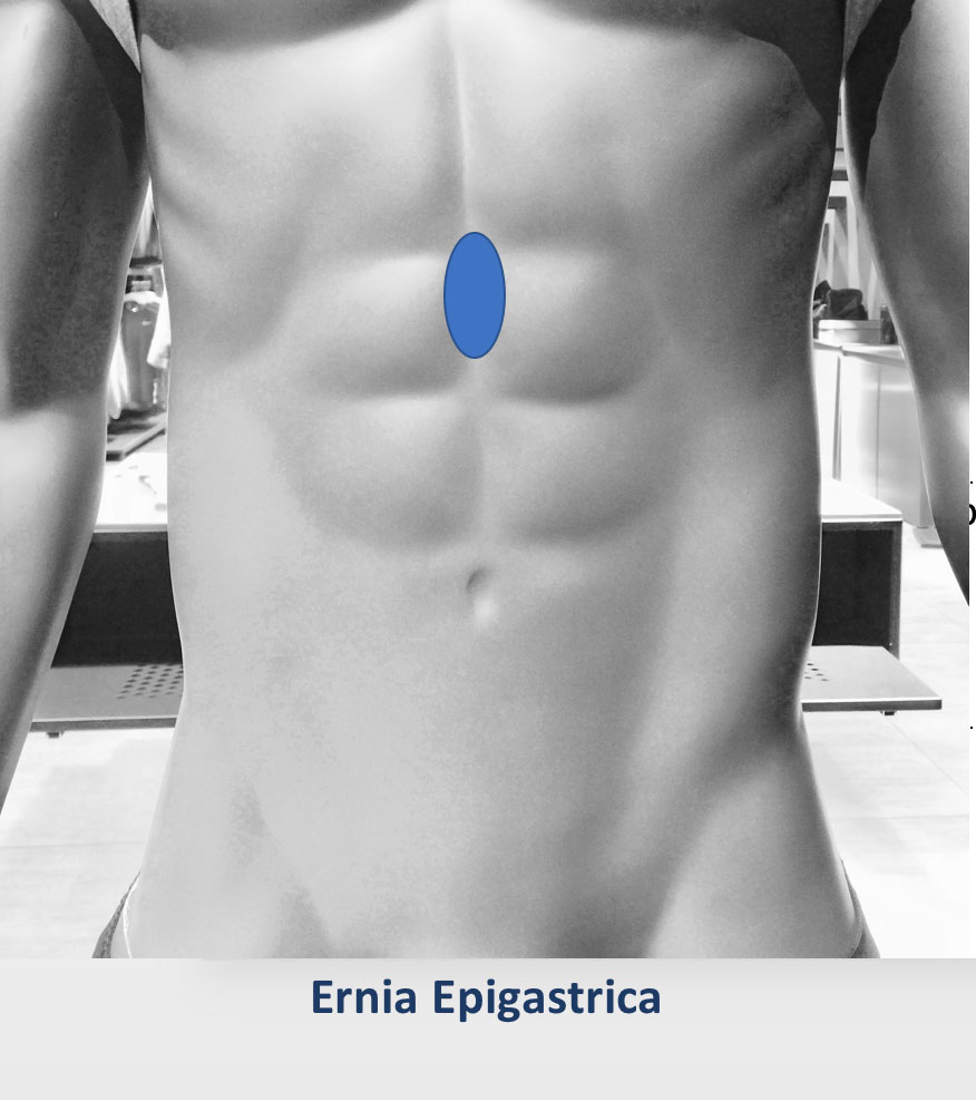 Ernia epigastrica
