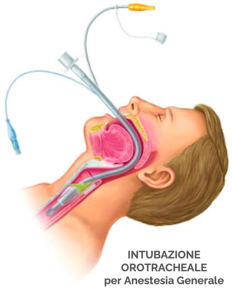 Intubazione anestesia generale