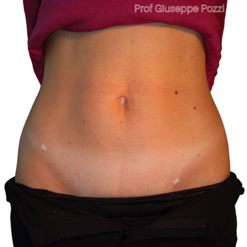 Cerottini mini laparoscopia