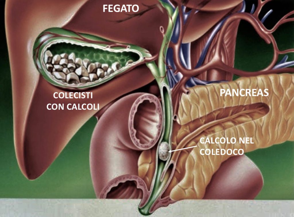 Colecistectomia