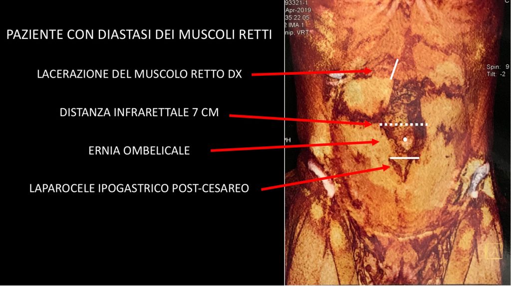 Diastasi muscoli retti