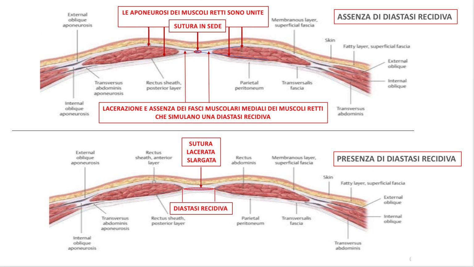 Diastasi recidiva schema