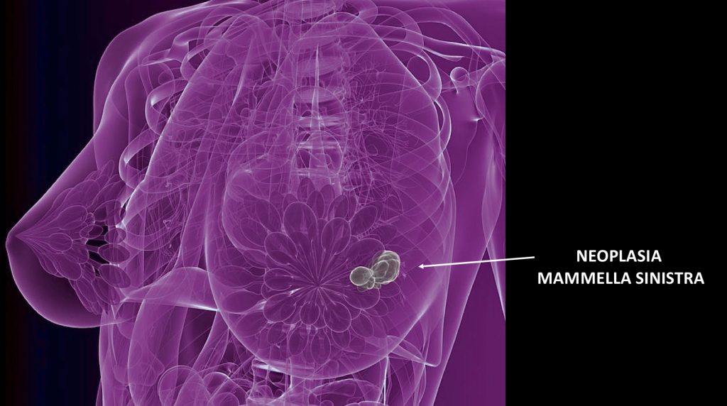 Neoplasia mammella sinistra