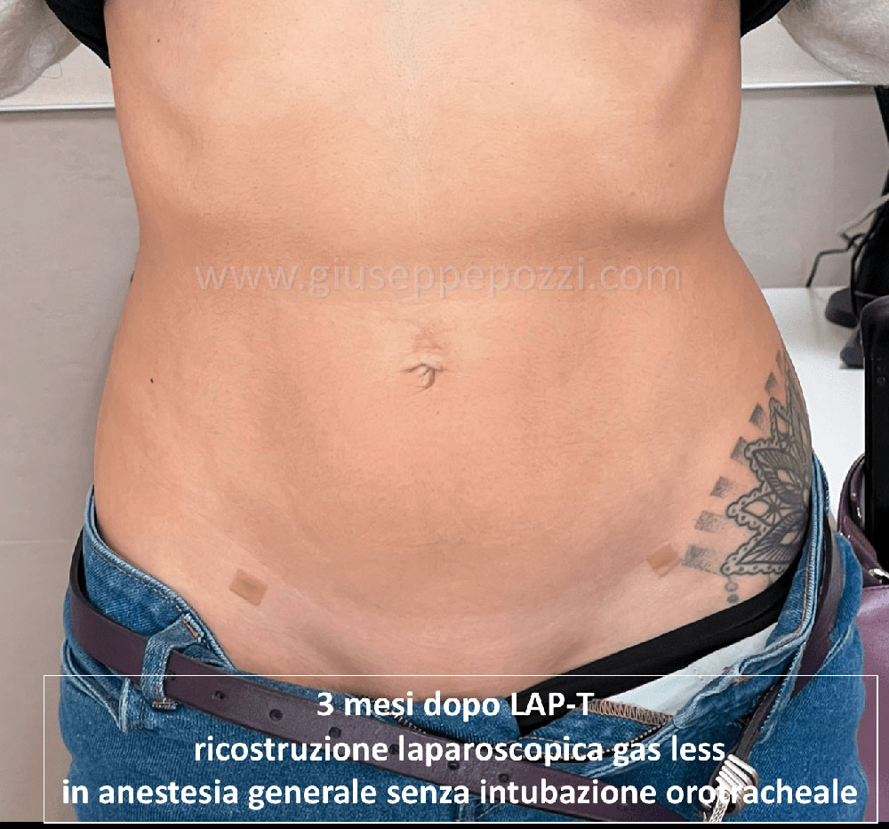 Diastasi muscoli retti post 2