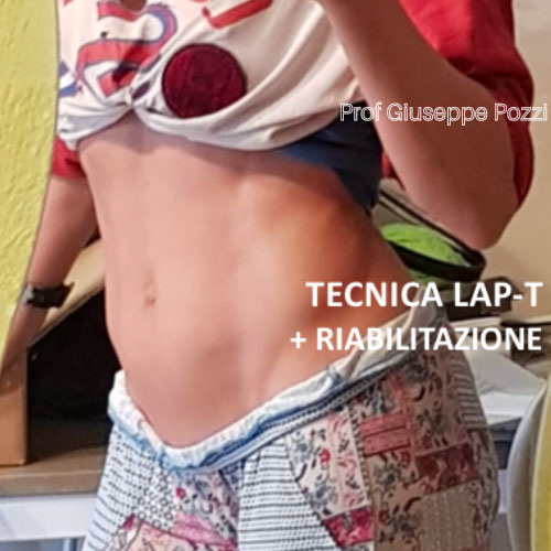 Diastasi muscoli retti post 4