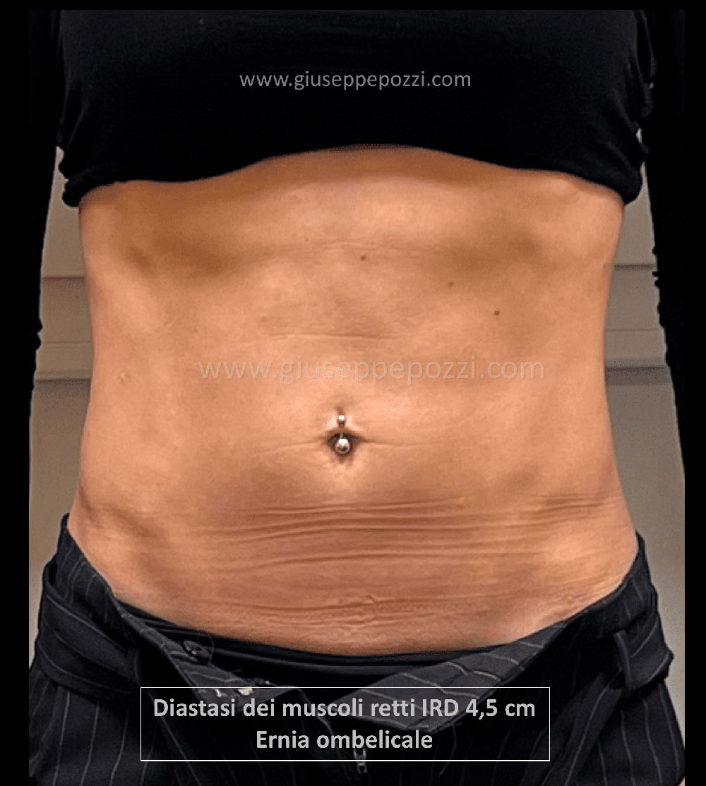 Diastasi muscoli retti pre 1