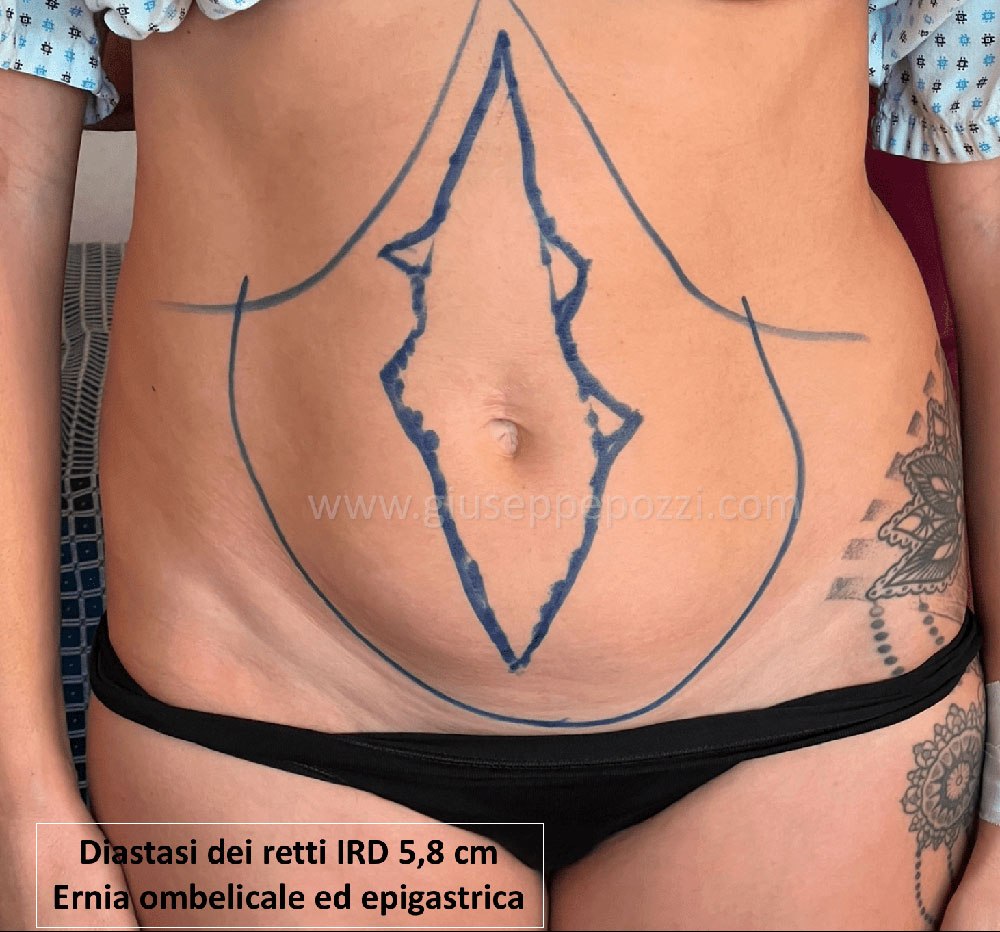 Diastasi muscoli retti pre 2