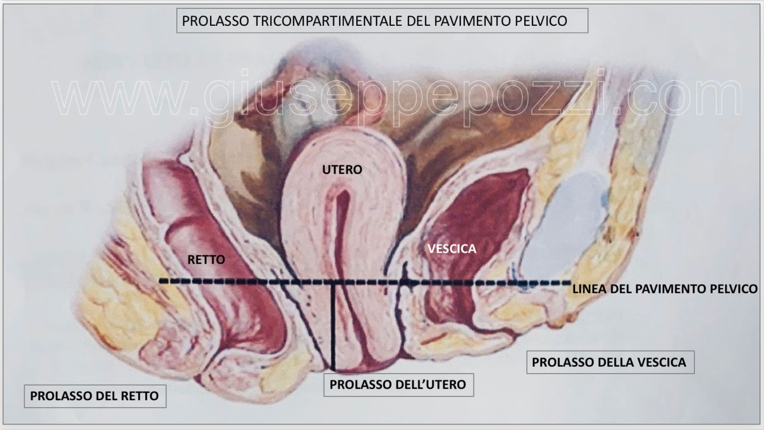 Prolasso pavimento pelvico