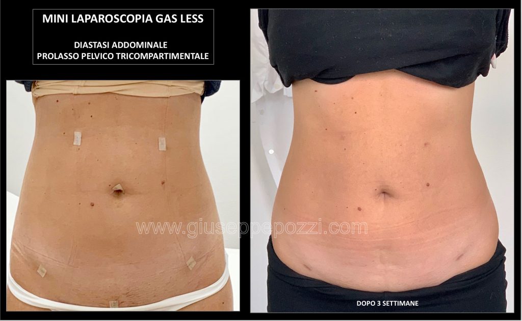 Prolasso pelvico e diastasi laparoscopia