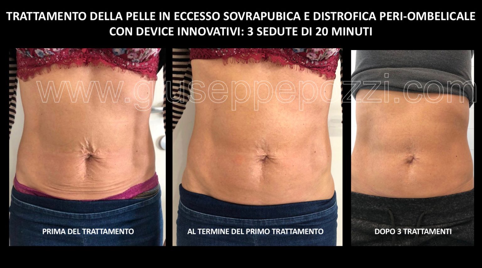 Trattamento pelle dopo LAP-T