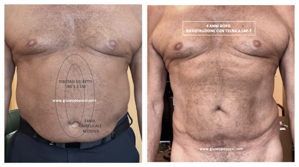 confronto di 2 immagini: immagine preparatoria di uomo con diastasi addominale ed ernia ombelicale recidiva. 4 anni dopo la ricostruzione con tecnica LAP-T®.