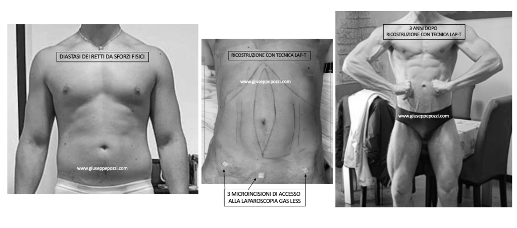 diastasi addominale nell'uomo: paziente con diastasi dei muscoli retti e lacerazione della linea mediana da sforzi fisici. Foto 3 anni dopo la ricostruzione con Tecnica LAP-T®