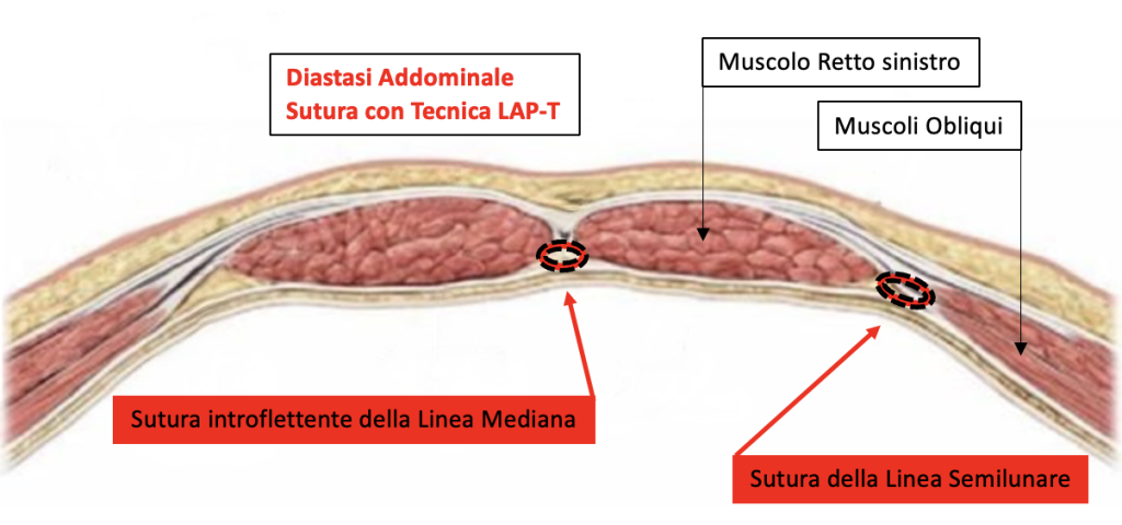 illustrazione della sutura della tecnica LAP-t® nella diastasi dei retti e nella diastasi addominale