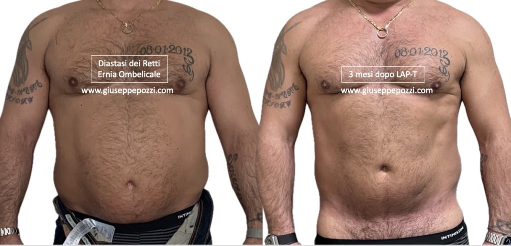 diastasi addominale nell'uomo: paziente con diastasi dei muscoli retti ed ernia ombelicale. Foto 3 mesi dopo la ricostruzione con Tecnica LAP-T®