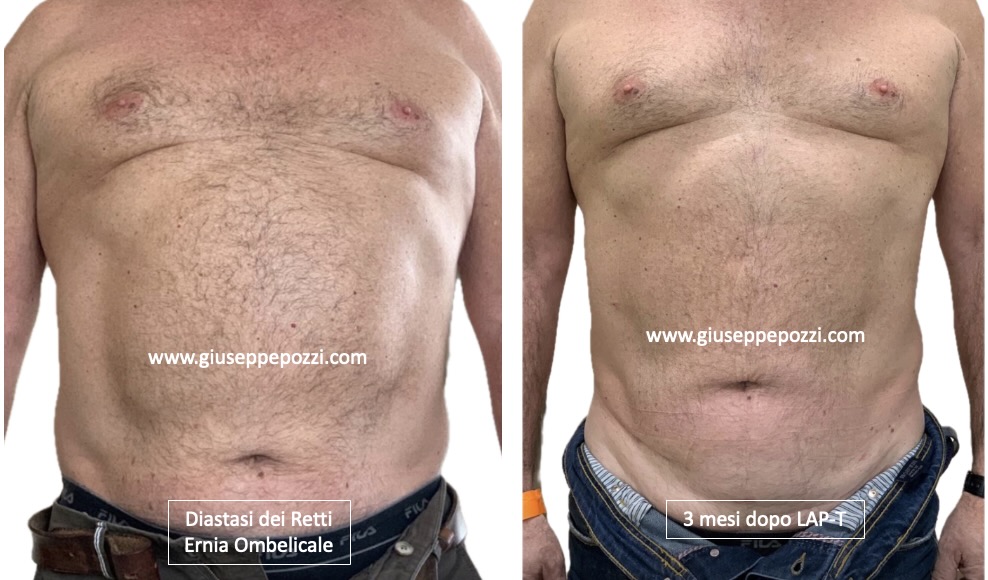 confronto di 2 immagini: immagine preoperatoria di uomo con diastasi addominale ed ernia ombelicale. 3 mesi dopo la ricostruzione con tecnica LAP-T®.