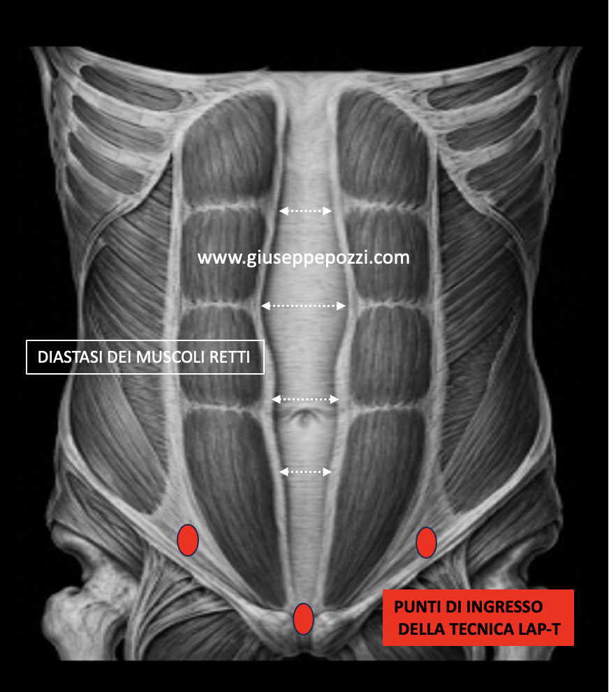 illustrazione grafica diastasi dei muscoli retti e punti di accesso per la ricostruzione con tecnica LAP-T®