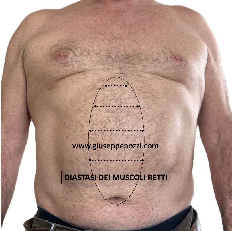 uomo con diastasi dei muscoli retti e diastasi addominale