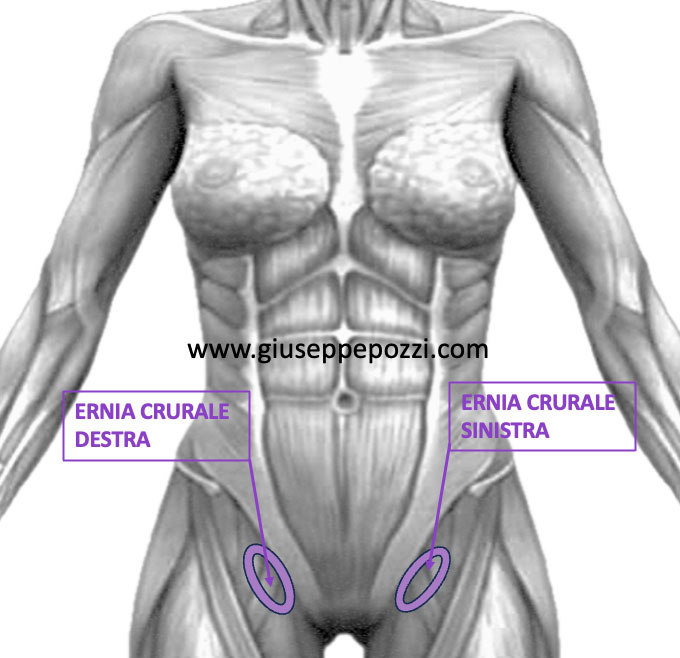 Ernia crurale