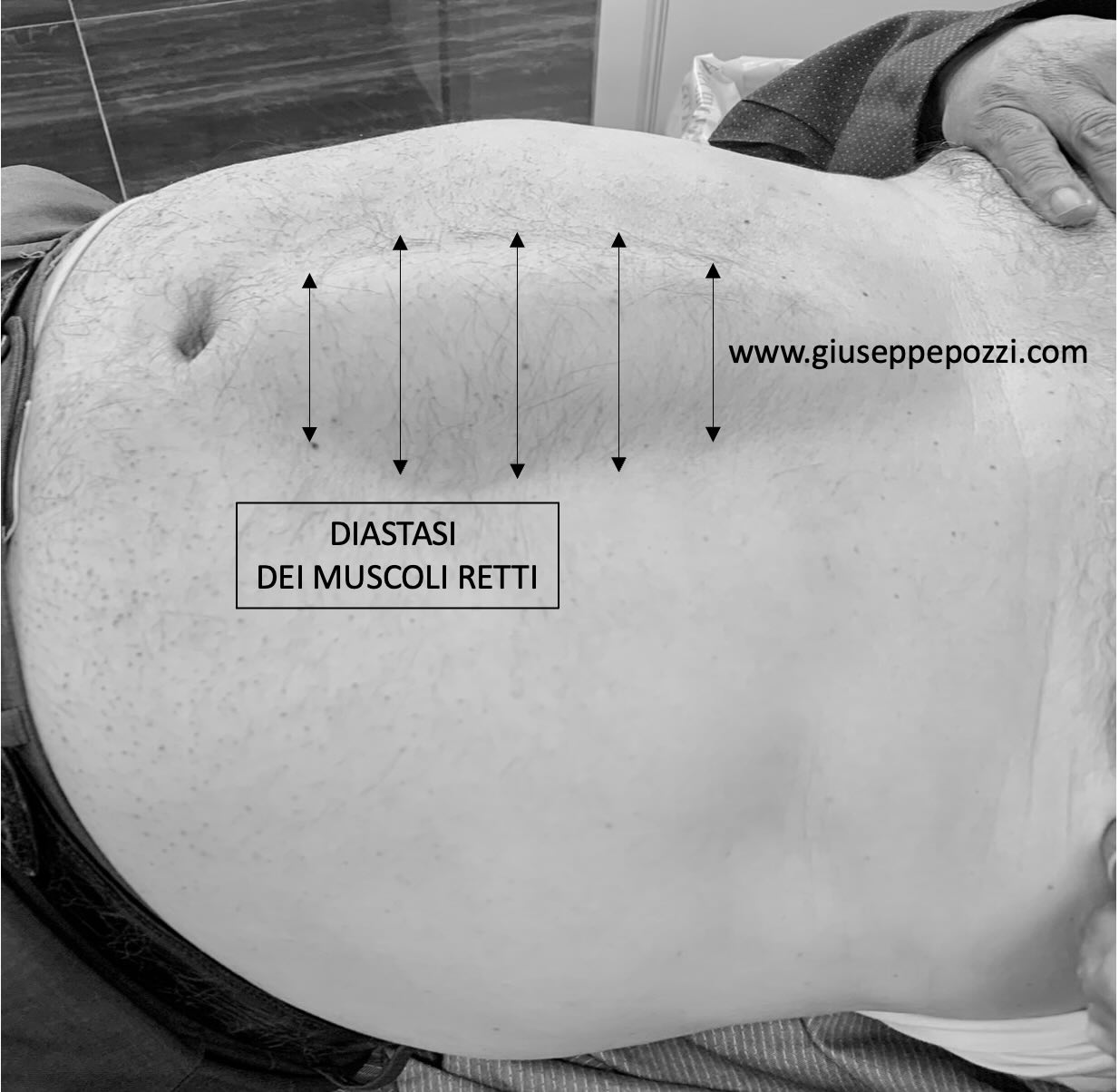addome uomo in contrazione con diastasi dei retti