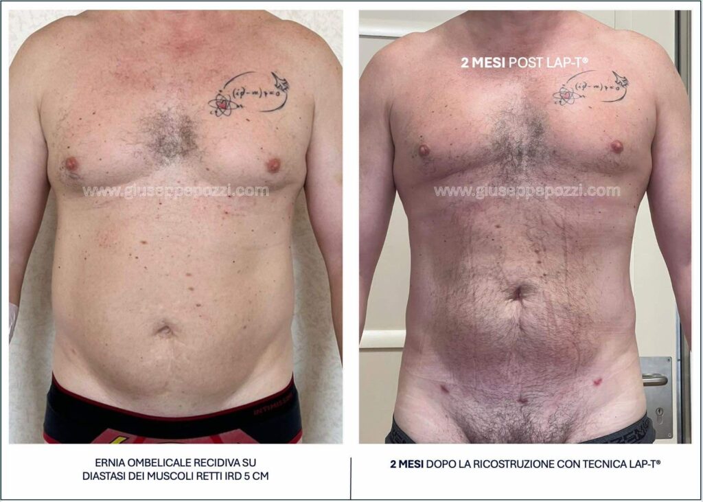 confronto di 2 immagini: immagine preoperatoria di uomo con diastasi addominale ed ernia ombelicale recidiva. 2 mesi dopo la ricostruzione con tecnica LAP-T®.