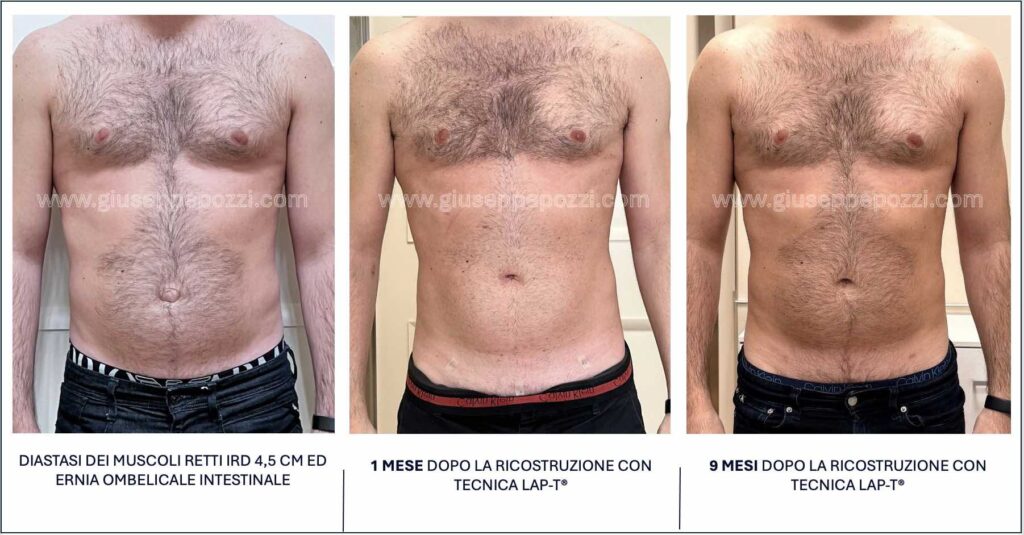 confronto di 3 immagini: immagine preoperatoria di uomo con diastasi addominale ed ernia ombelicale. 1 mese dopo la ricostruzione con tecnica LAP-T®. 9 mesi dopo la ricostruzione con tecnica LAP-T®