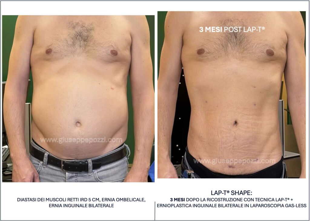 confronto di 2 immagini: immagine preoperatoria di uomo con diastasi addominale, ernia ombelicale ed ernia inguinale bilaterale. LAP-T Shape: 3 mesi dopo la ricostruzione con tecnica LAP-T®.
