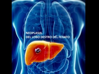 Chirurgia oncologica gallery 2