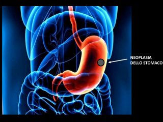 Chirurgia oncologica gallery 4