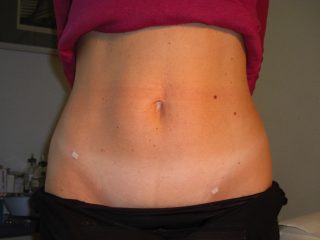 Mini Laparoscopia