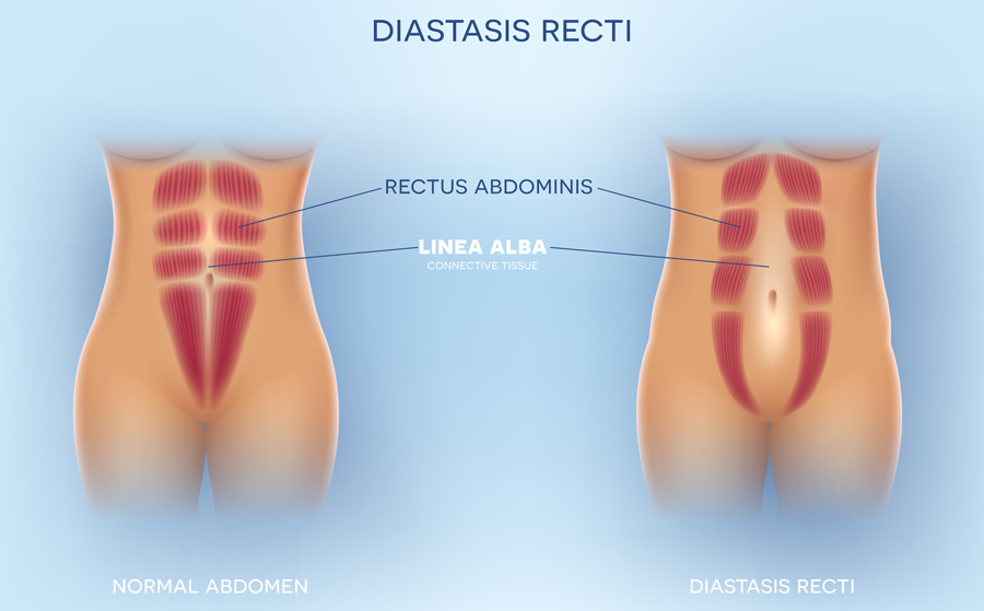diastasi addominale