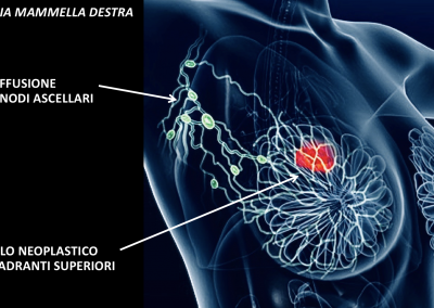 chirurgia tumore al seno