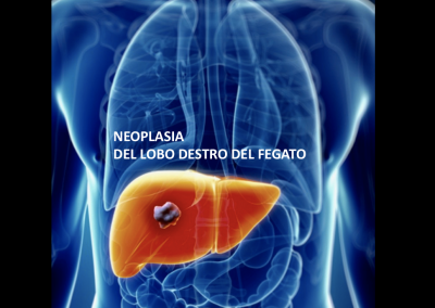 chirurgia oncologica addome