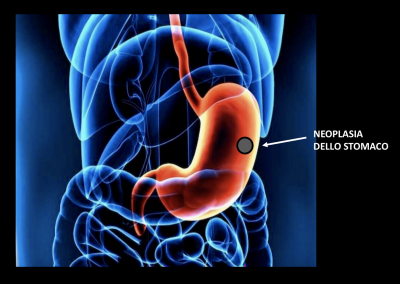 chirurgia oncologica addome