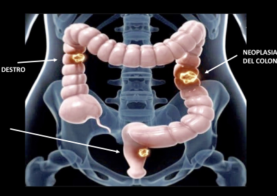 chirurgia oncologica addome