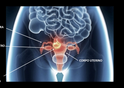 chirurgia oncologica pelvi