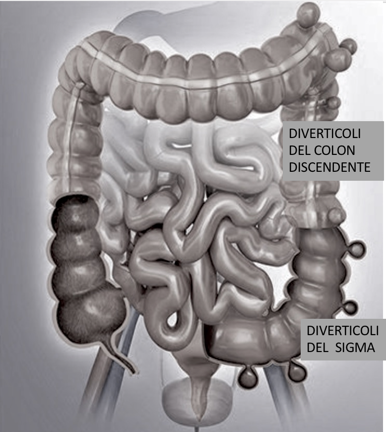 immagine diverticoli colon discendenti