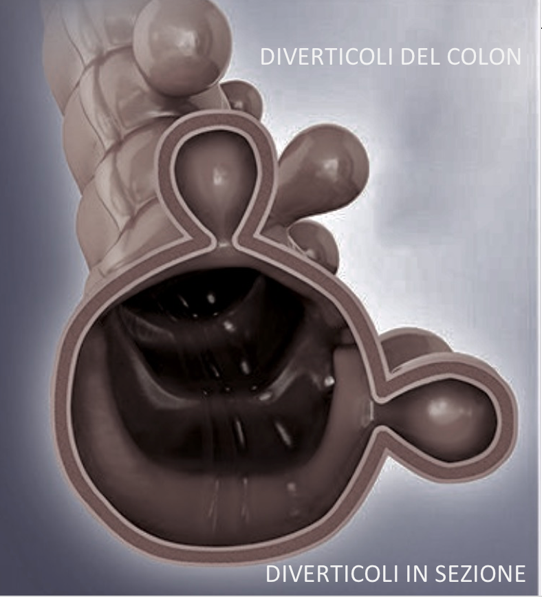 immagine diverticoli colon in sezione