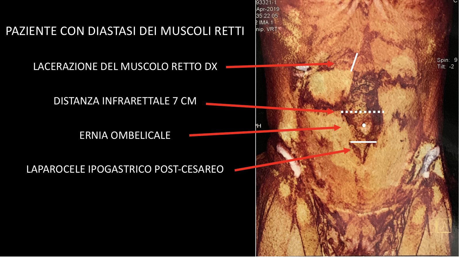 diastasi lacerazioni