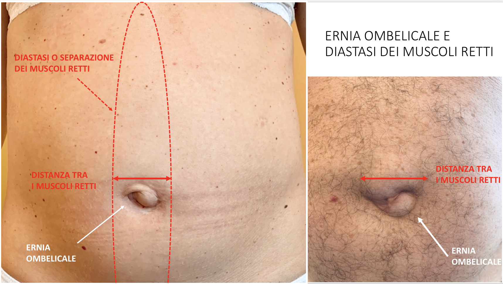 ernia ombelicale e diastasi