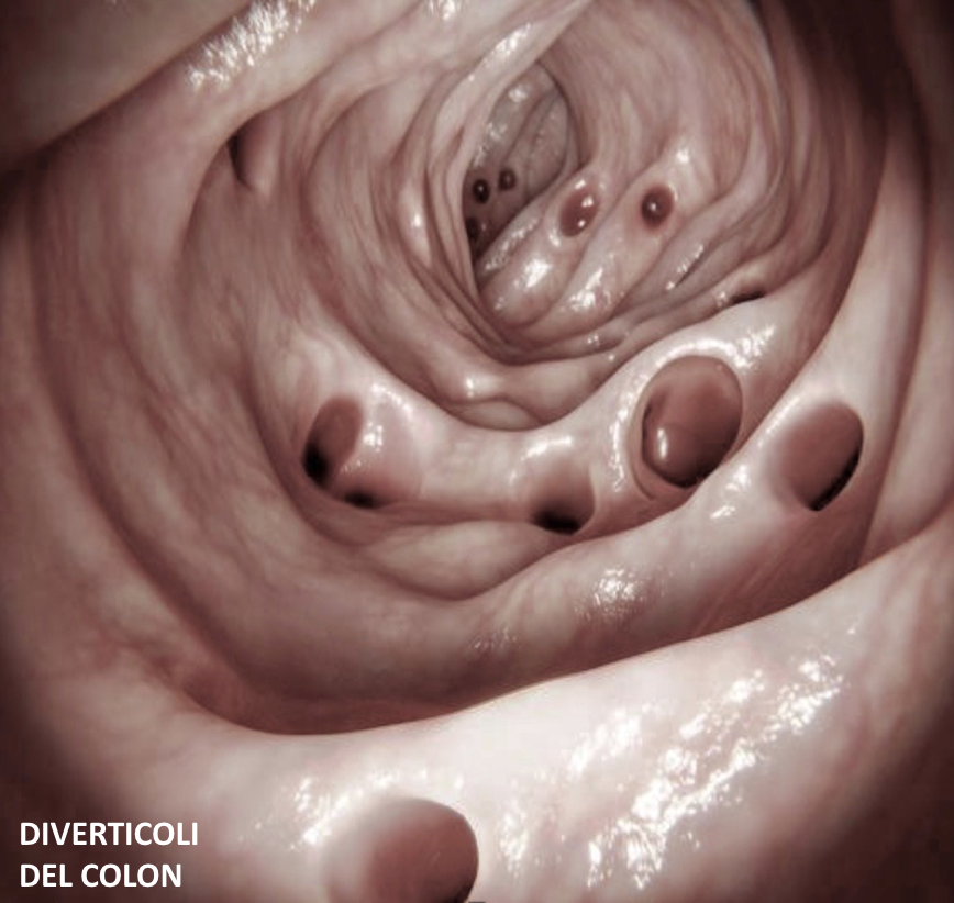 immagine diverticoli