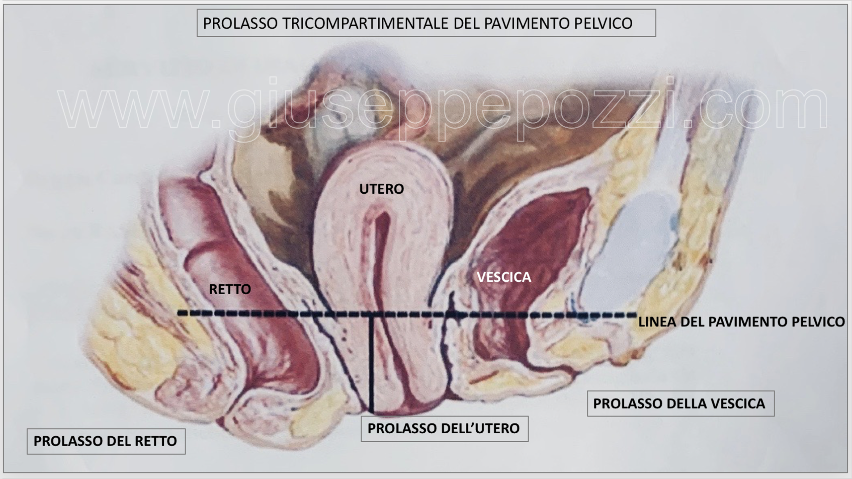 pavimento pelvico disegno prolasso