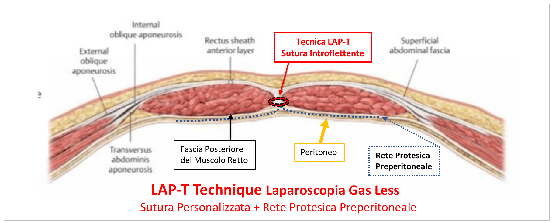 rete protesica disegno