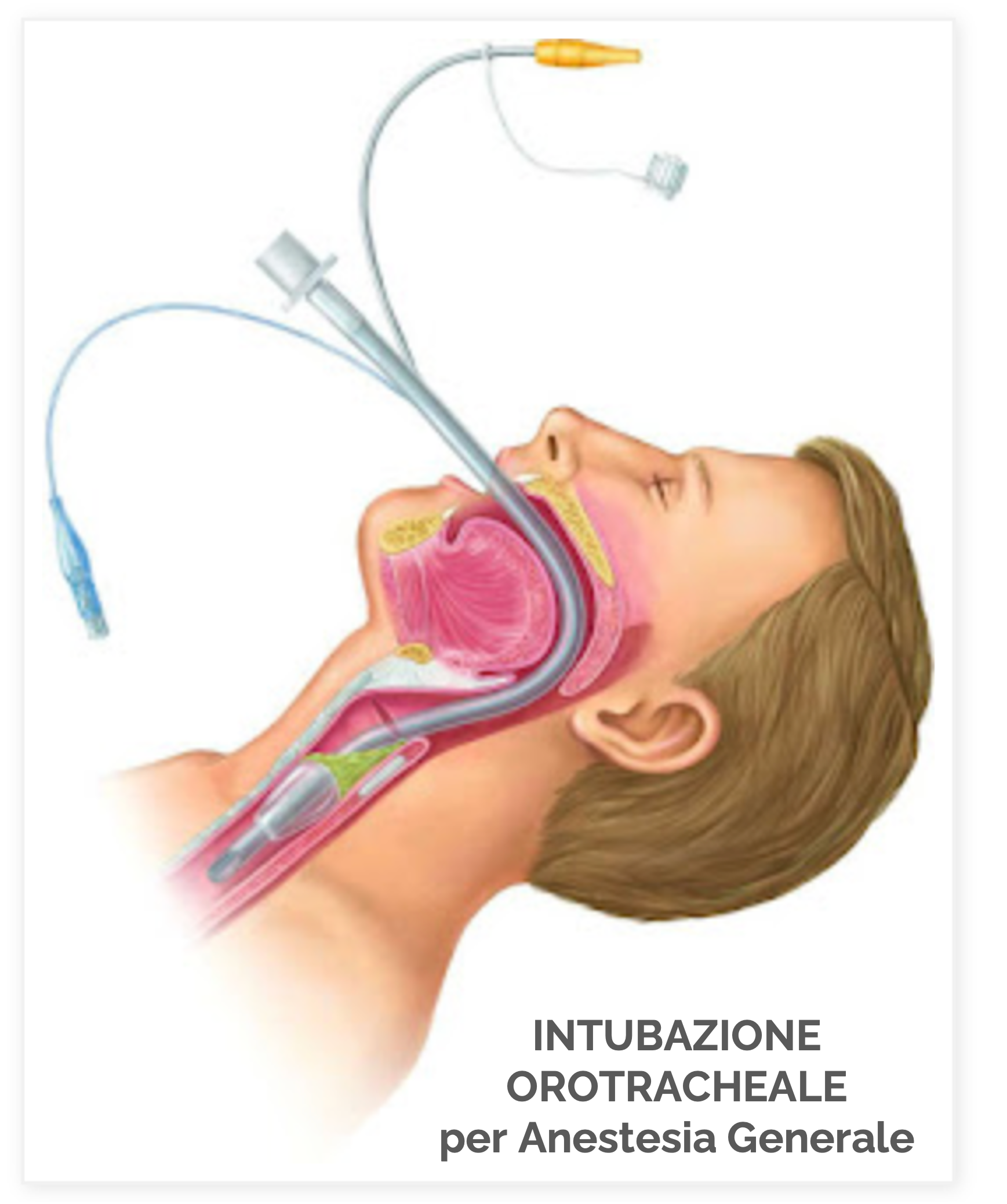 disegno anestesia generale intubazione 