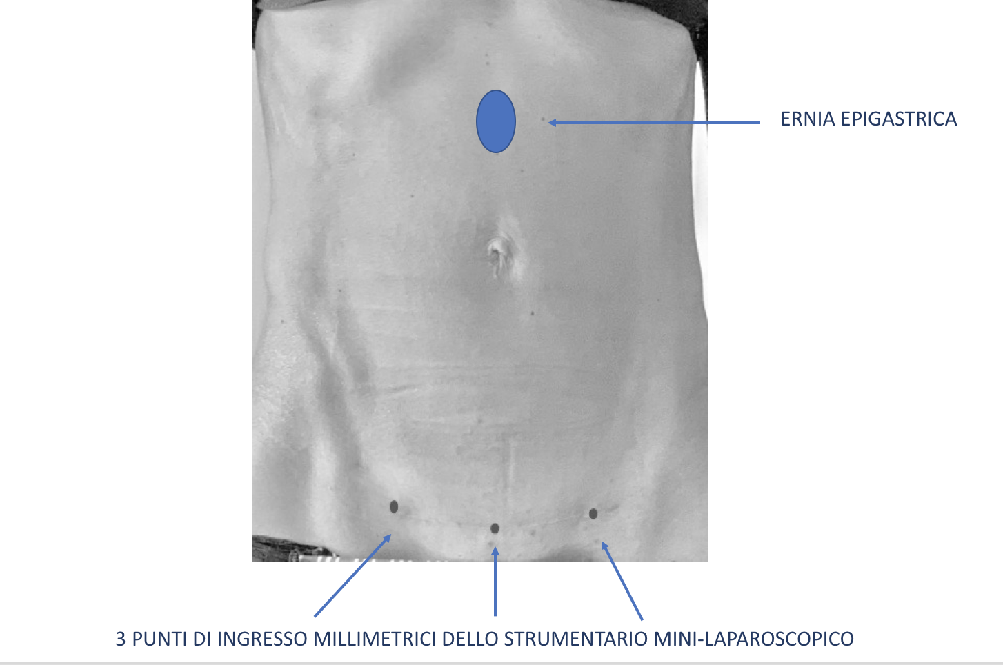 ernia epigastrica punti accesso