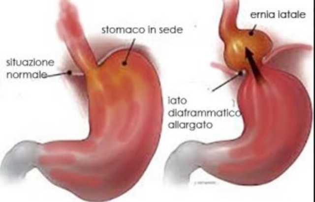 ernia iatale disegno